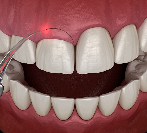 Digital illustration of laser gum recontouring