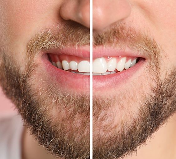 Man before and after gum recontouring