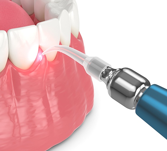 Digital illustration of gum recontouring