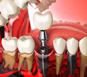 Model showing each part of a dental implant