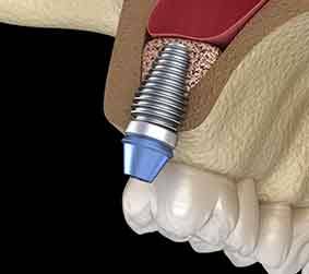 Implant post treating upper tooth