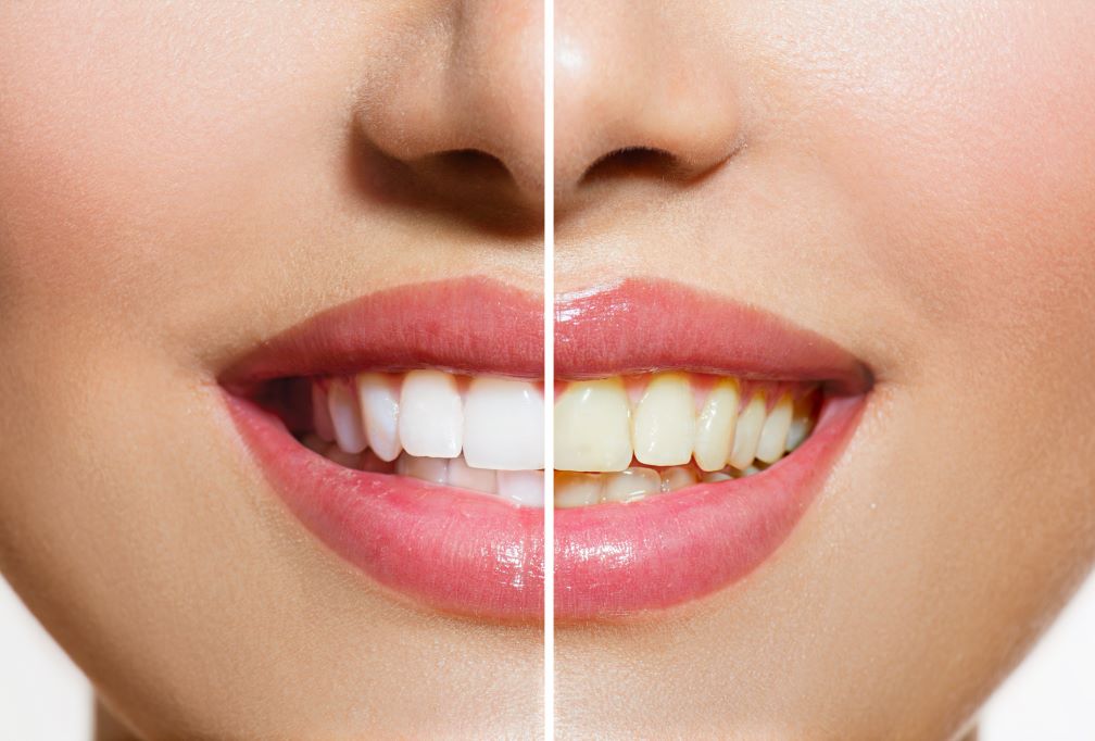 A woman's teeth before and after a professional teeth whitening treatment.